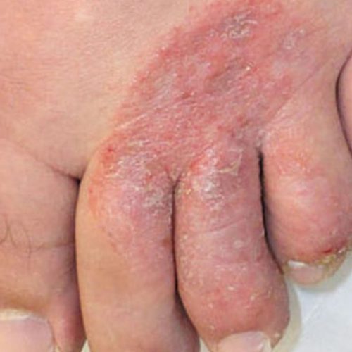 athletes foot, tinea pedis, fungal skin infection