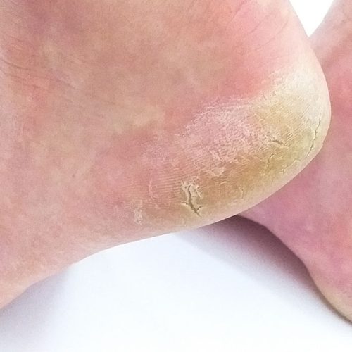 cracked heels, callus, fissures