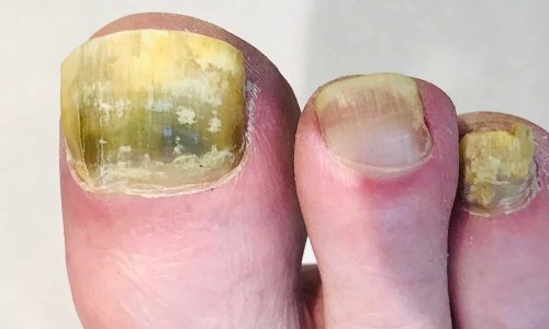 onychomycosis, fungal nail infection