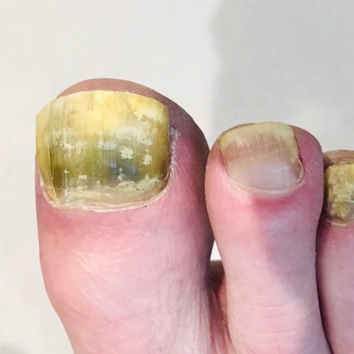 onychomycosis, fungal nail infection