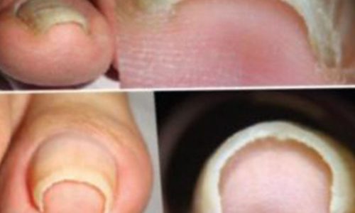 Onychocryptosis, ingrowing, involuted toenails