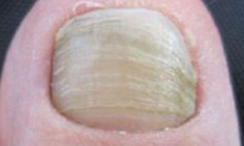 onychauxis, thickened damaged nails
